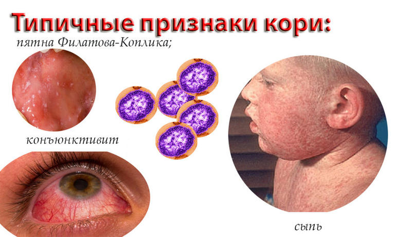 Эпидемия кори в Украине: что нужно знать об опасном вирусе?